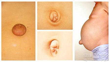 成人脐疝可以根治吗视频,揭秘治愈秘诀