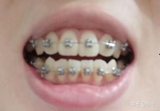 牙棒成人矫正视频播放,轻松掌握矫正技巧