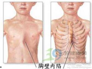 成人女性鸡胸治疗方法视频,成人女性鸡胸治疗视频攻略